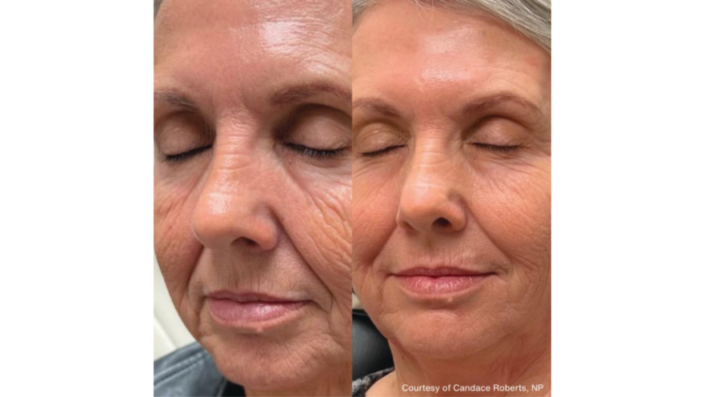 Skin Rejuvenation Des Moines