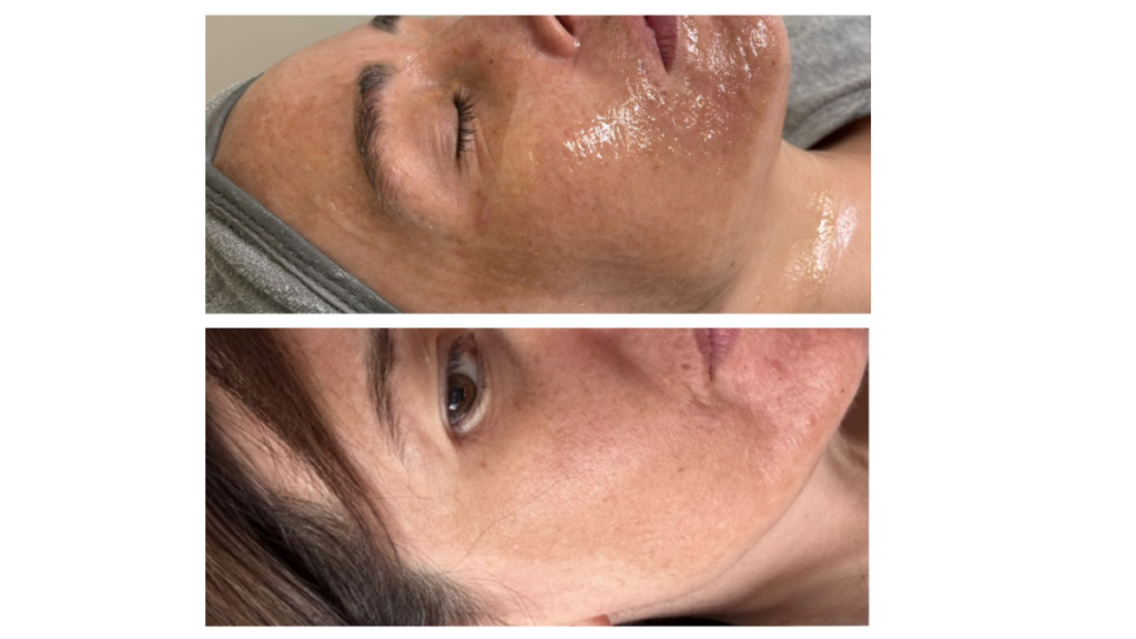 Skin Rejuvenation Des Moines