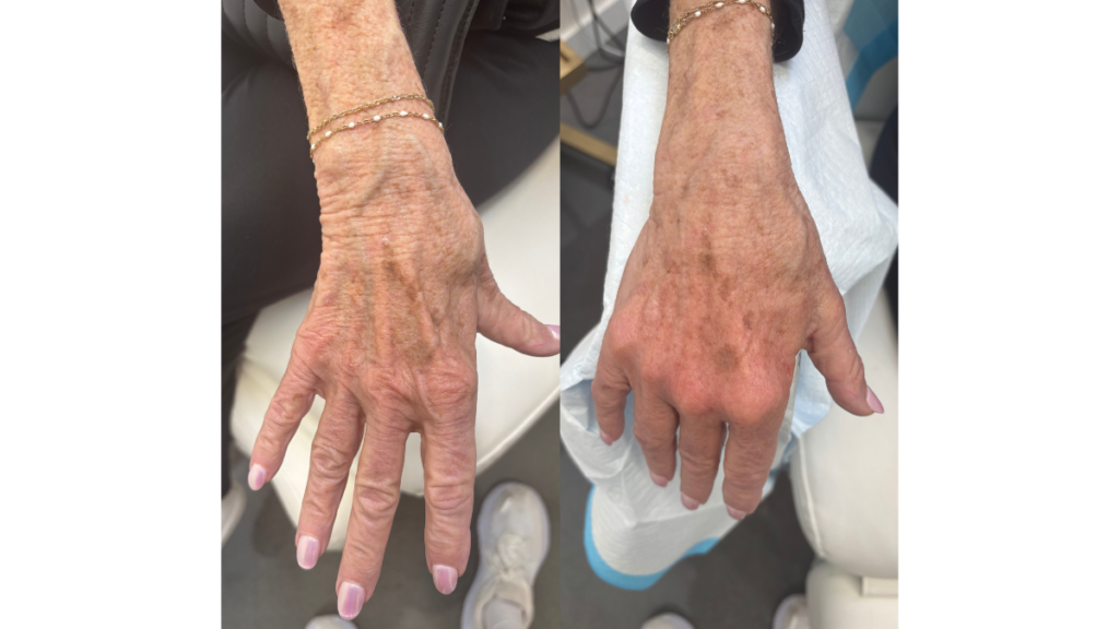 Skin Rejuvenation Des Moines