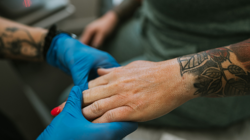 CO2 Hand Rejuvenation